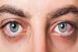 علل موثر در بروز آب مروارید +اینفوگرافیک 