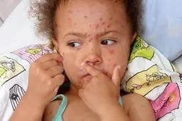 مادران نگران از ابتلای فرزندانشان به سرخک بخوانند ‌