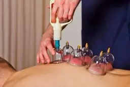 بادکش نکنید | هشدار جدی درباره  بادکش بدن 