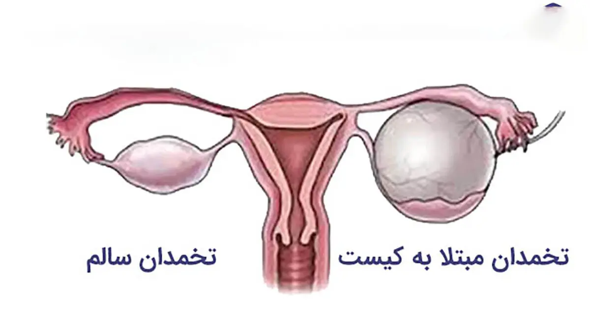 کیست تخمدان چیست؟ | معرفی علائم ترکیدن کیست تخمدان و راه درمان آن
