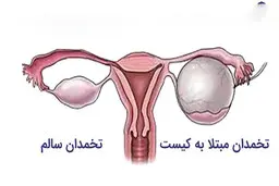 کیست تخمدان چیست؟ | آیا کیست تخمدان برای بارداری خطرناک است؟