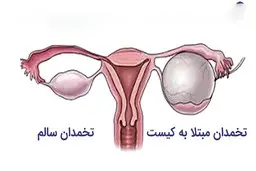 کیست تخمدان چیست؟ | معرفی علائم ترکیدن کیست تخمدان و راه درمان آن
