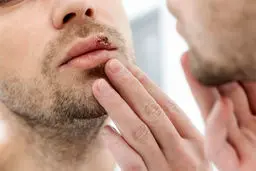 ویروس تبخال تناسلی چیست ؟ | آیا راه درمانی دارد؟