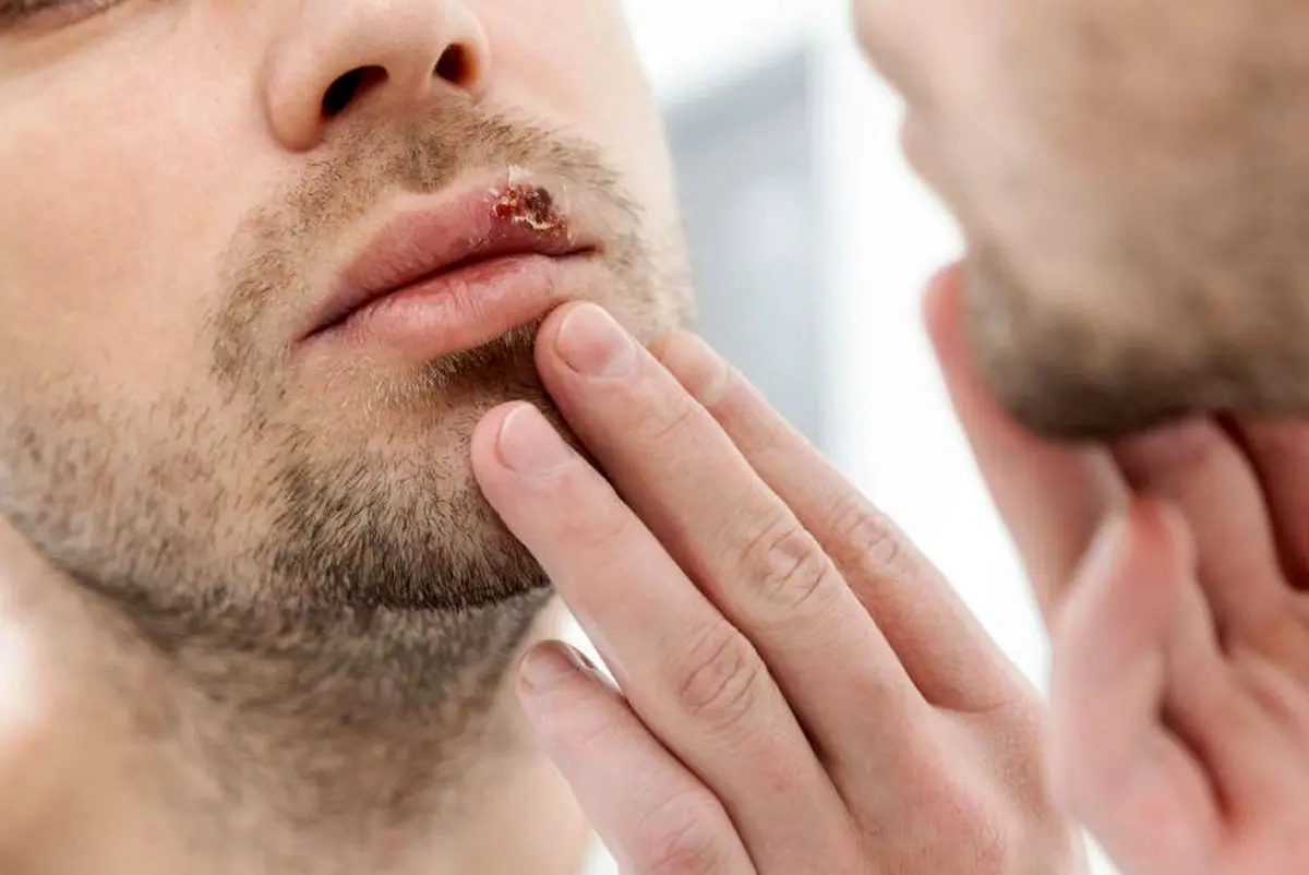 ویروس تبخال تناسلی چیست ؟ | آیا راه درمانی دارد؟