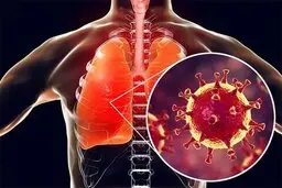  بیماران مبتلا |نحوه مراقبت از بیماران مبتلا به کووید -۱۹ خفیف در منزل ؟