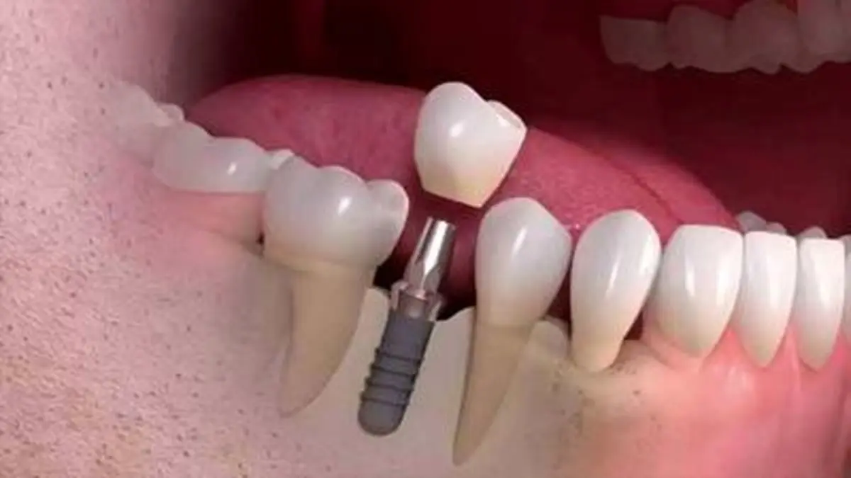 عوارض جای خالی دندان ها‌ در دهان | بلایی خطرناکی که جای خالی دندان ها سرتان می آورد