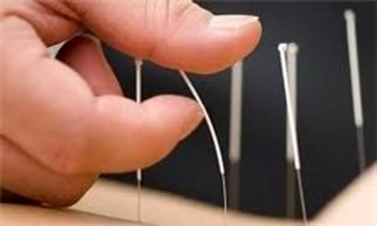 تاثیر طب سوزنی بر کاهش استرس 