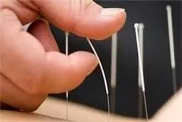 تاثیر طب سوزنی بر کاهش استرس 