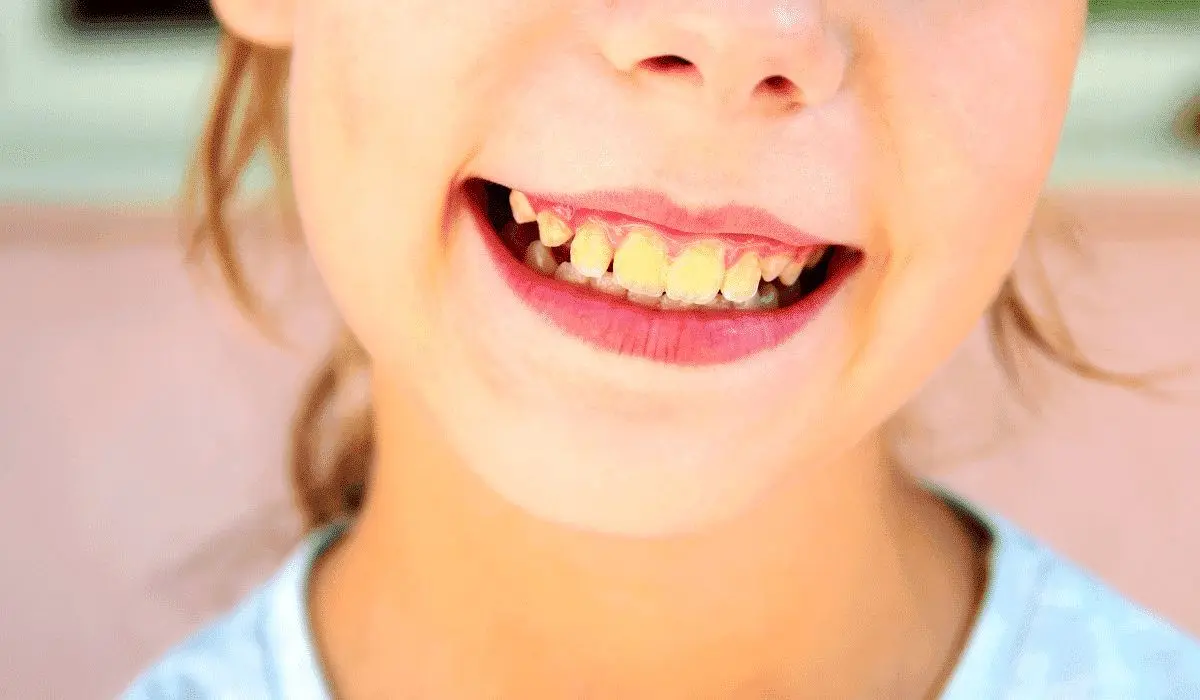 علت زرد شدن دندان‌ ها چیست؟ | درمان خانگی زردی دندان ها