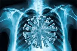 
علائم درگیری ریه در مبتلایانِ کرونا  | درگیری ریه در همه بیماران دیده نمی‌شود
