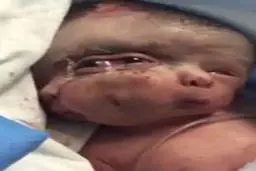 تولد یک نوزاد سه چشم در هند! | این بچه چرا اینطوری به دنیا اومده؟ + ویدئو