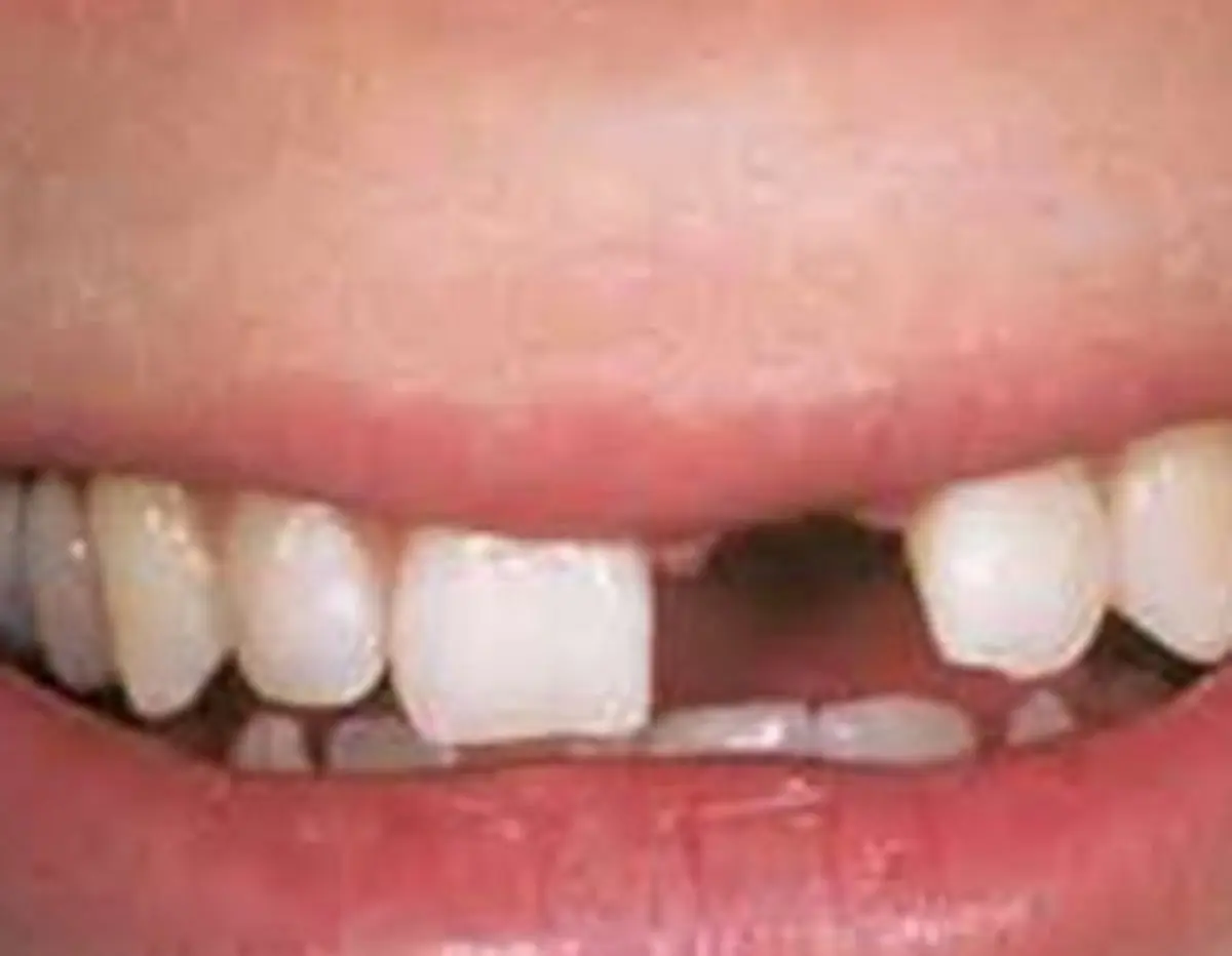 ۵ تا ۶ میلیون ایرانی بی دندان کامل هستند