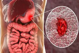 بهترین روش درمان ورم معده با آب سیب زمینی + ویدیو 