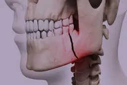 ۸۷ درصد کودکان ایرانی زیر ۶ سال دندان پوسیده دارند