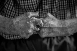 12مورد جدید جذام در سال گذشته | چالش شناسایی بیماری در کشور