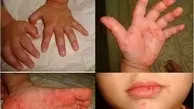 شیوع گسترده یک ویروس جدید در ایران | بیماری  «دست، پا، دهان» فقط با کودکان سر و کار دارد!