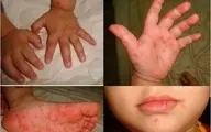 شیوع گسترده یک ویروس جدید در ایران | بیماری  «دست، پا، دهان» فقط با کودکان سر و کار دارد!