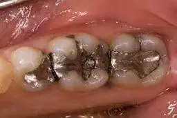 چه زمانی باید پر کننده دندان را تعویض کرد؟