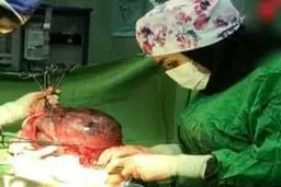 توده بزرگ‌ چند کیلویی  از شکم زن  رشتی بیرون کشیده شد | این زن حامله بود