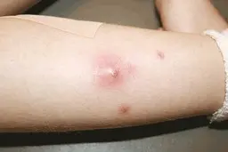  شناخت  5بیماری پوستی که مرتبط با کرونا میباشد