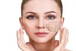آیا پوست خشکی دارید ؟ | با این روش ها به پوست خود طراوت هدیه کنید! | درمان خشکی پوست