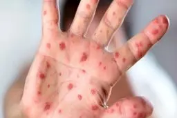 شناسایی ۱۳۲ بیمار مبتلا به سرخک در کشور | واکسیناسیون سرخک برای اتباع خارجی نیز رایگان است
