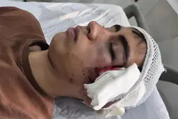 مصدومیت شدید دانش‌آموز دهبکری در درگیری با معلم | روایت پدر از ضرب‌وشتم با دسته صندلی