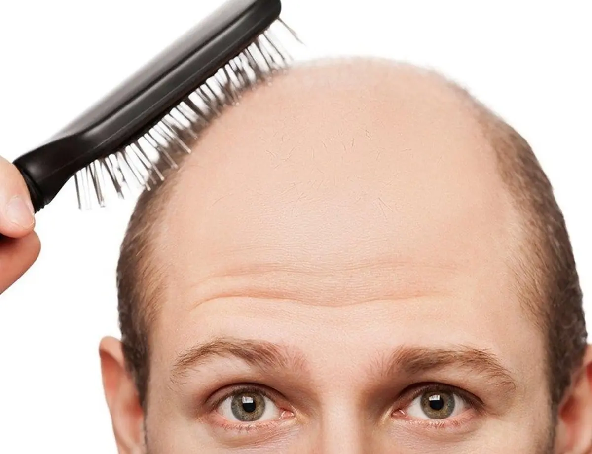 طب سنتی ریزش موهایتان را درمان می کند