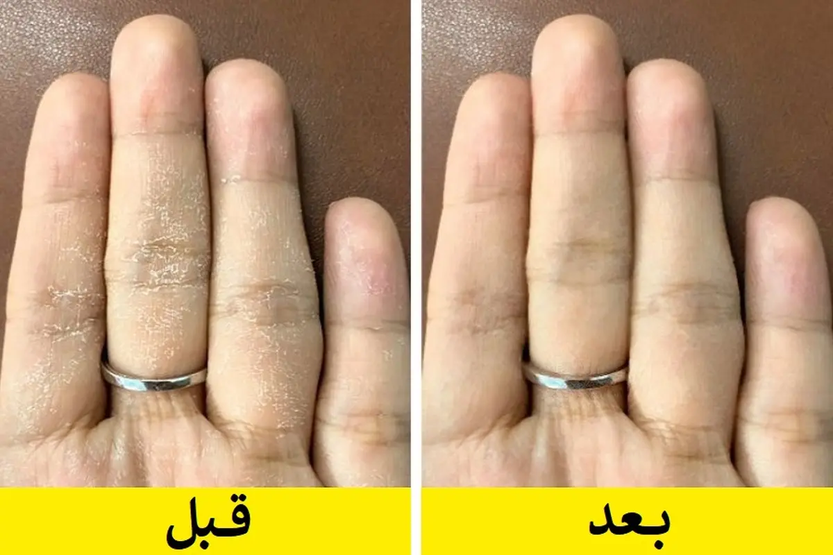 ۵ خوردنی مفید برای رفع خشکی پوست