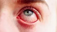  درمان خانگی قرمزی چشم 