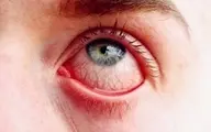  درمان خانگی قرمزی چشم 