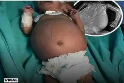 تولد نوزاد حامله! | وقتی نوزاد آخر الزمانی با یک جنین دیگر در شکمش به دنیا می‌آید!