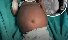 تولد نوزاد حامله! | وقتی نوزاد آخر الزمانی با یک جنین دیگر در شکمش به دنیا می‌آید!