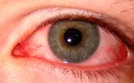 محققان: عارضه چشم صورتی نشانه ویروس کروناست