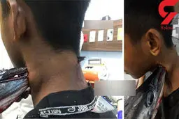 عکس وحشتناک از فرورفتن دهان ماهی نیزه‌ای در گردن نوجوان بوشهری 