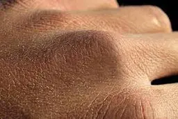 کرونا و خشکی پوست
