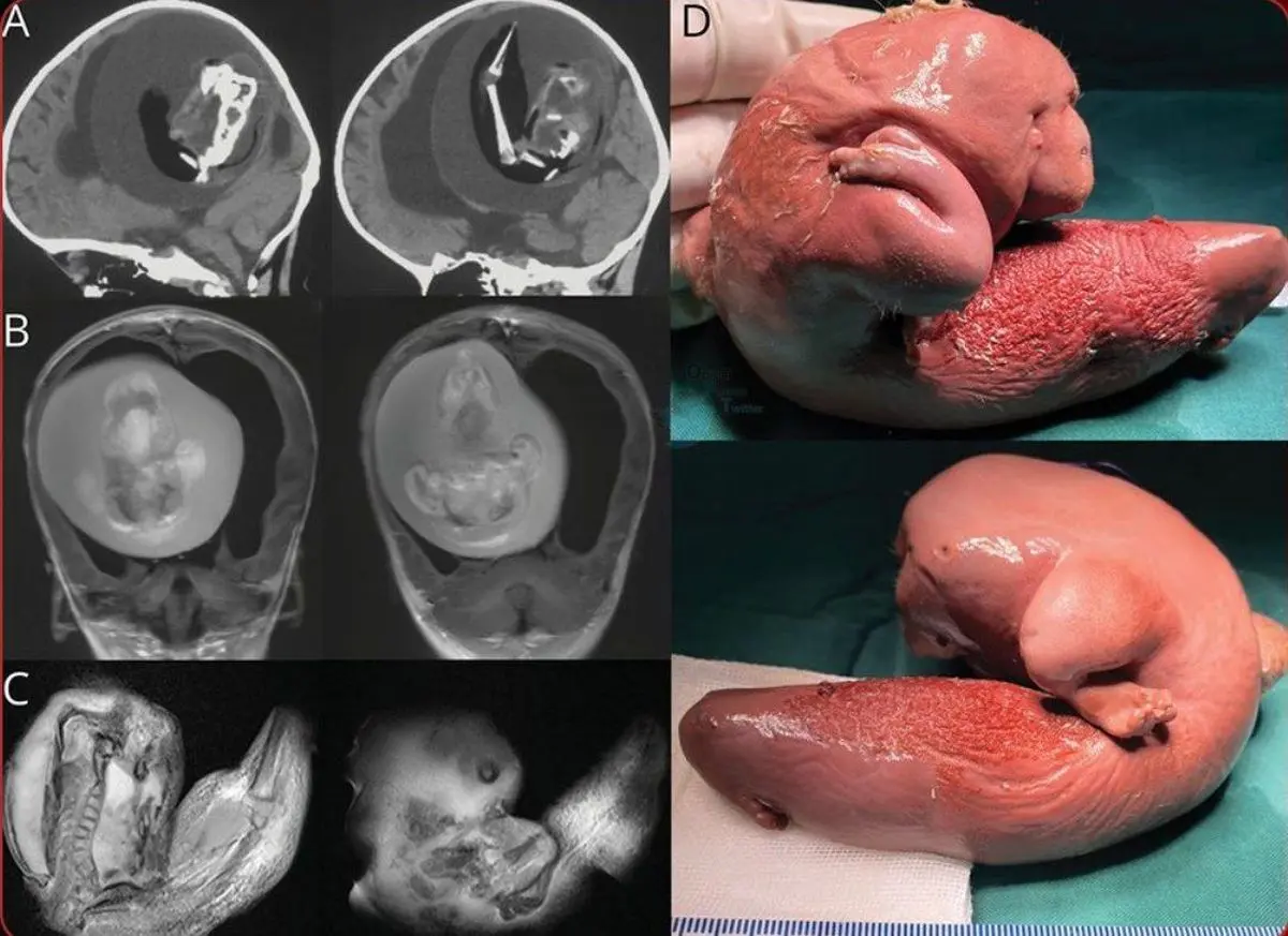 کشف جنین دو قلو در مغز یک دختر بچه ۱ ساله | ۱۰ سانتی متر رشد کرده بوده! + عکس