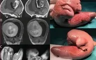 کشف جنین دو قلو در مغز یک دختر بچه ۱ ساله | ۱۰ سانتی متر رشد کرده بوده! + عکس