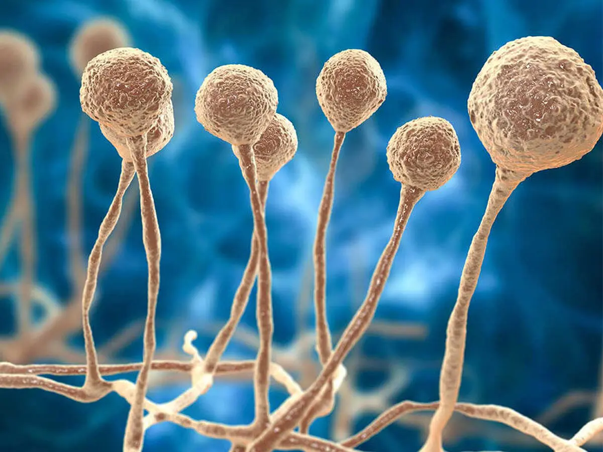 نخستین بیمار مبتلا به قارچ سیاه در نیشابور شناسایی شد
