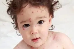 واکسن آبله دشمن آبله میمونی | بهترین راه پیشگیری در برابر آبله میمونی
