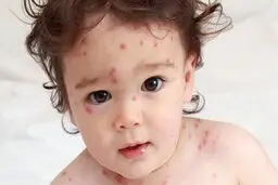 واکسن آبله دشمن آبله میمونی | بهترین راه پیشگیری در برابر آبله میمونی