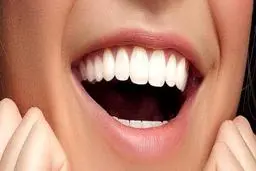 هر آنچه که باید در باب روکش دندان بدانیم