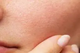 اگر پوست چرب دارید حتما این موارد را بخوانید