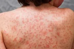 علت بیماری کاوازاکی چیست و چه علائمی دارد؟