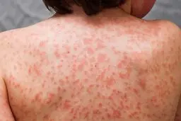 علت بیماری کاوازاکی چیست و چه علائمی دارد؟