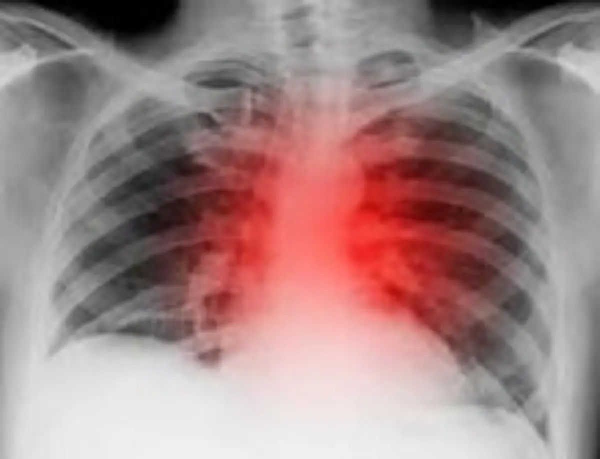 کاهش ابتلا به بیماری قلبی با زندگی در مناطق سرسبز 