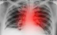 کاهش ابتلا به بیماری قلبی با زندگی در مناطق سرسبز 