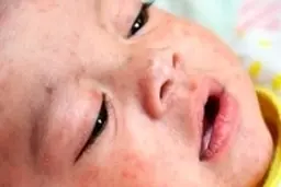  آیا بزرگسالان هم به سرخک مبتلا می‌شوند؟