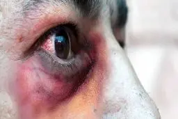 یک  بیمار مشکوک به قارچ سیاه در  اردبیل شناسایی شد