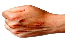 بیماری پسوریازیس چیست؟ 